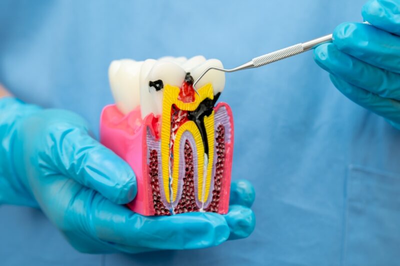 root canals orem